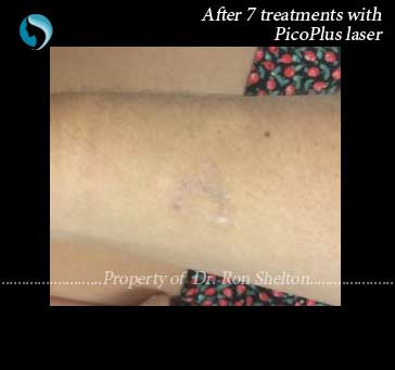 After 7 treatments with PicoPlus laser