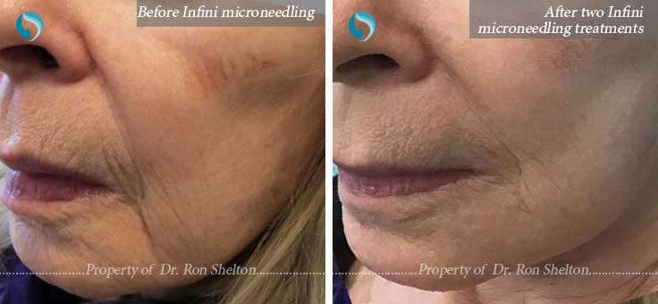 Infini Microneedling on cheek wrinkles