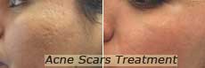 Acne scar treatment nyc