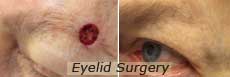 Eye lid surgery nyc