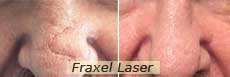 Fraxel laser in nyc