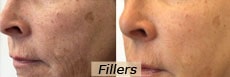 <a href="/gallery/fillers"> Fillers</a>