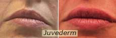 Juvederm in NYC