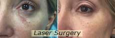 Laser Surgery NYC