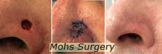 Mohs surgery in NYC