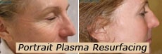 Plasma resurfacing