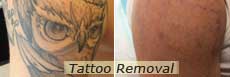 Tattoo Removal nyc