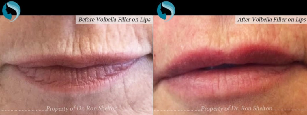 volbella for lip volume NYC