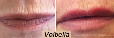 Volbella