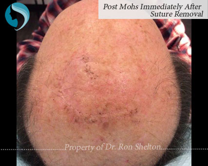 image of Post Mohs Immediately After Suture Removal