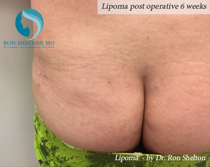 Lipoma post operative 6 weeks