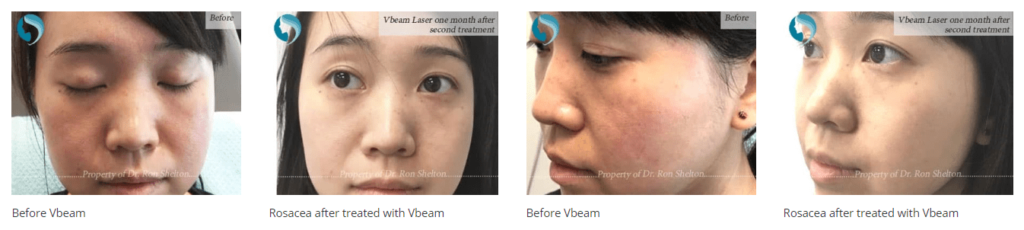 vbeam laser before and after in nyc