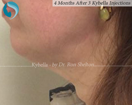 3 Months after 3 Kybella treatments