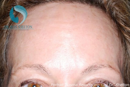 After Portrait Plasma Resurfacing for Acne Scars