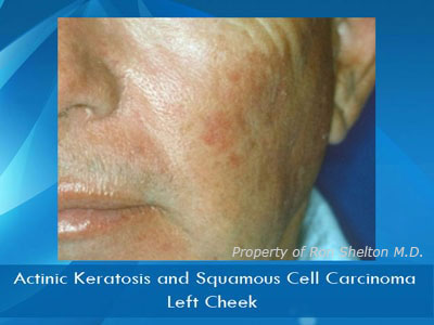 Actinic Keratosis and Squamous Cell Carcinoma