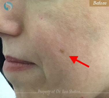 before treatment for brown spot