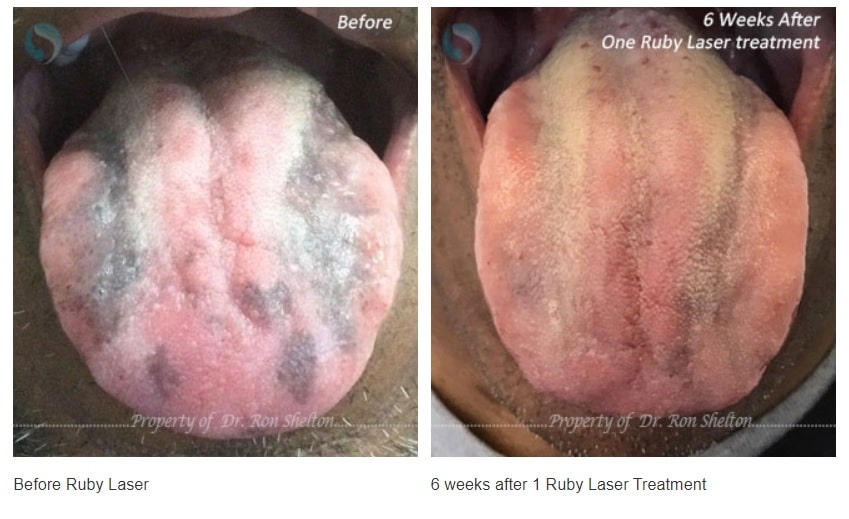 ruby laser for tongue pgmentation nyc