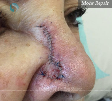 Mohs Repair surgery in New york