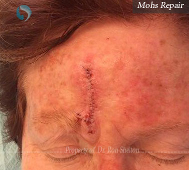 Mohs repair by Ron Shelton MD