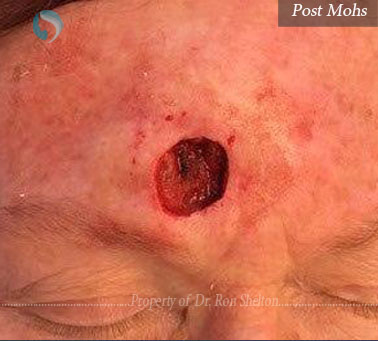 Post Mohs surgery by Ron Shelton MD