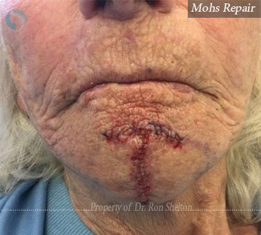 Mohs Repair on the chin