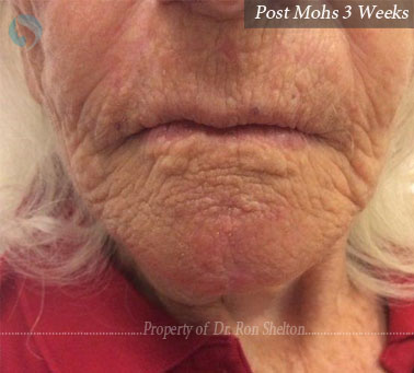 Post Mohs 3 Weeks on chin