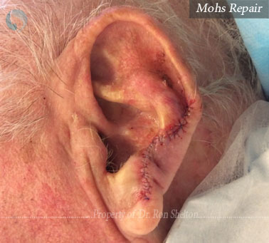 Mohs Repair on ear