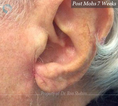 Post Mohs 8 weeks on ear