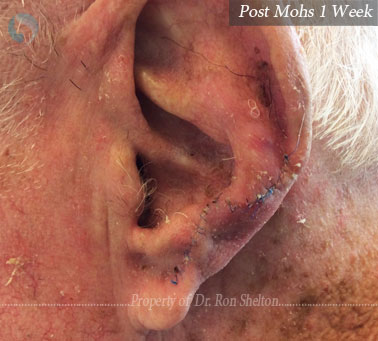 Post Mohs one week on ear