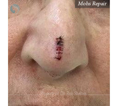 Mohs Repair on nose by Dr Shelton