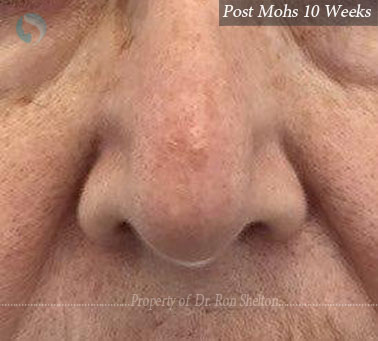 Post Mohs 10 Weeks by Dr Shelton