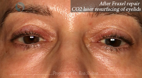 After Fraxel repair CO2 laser resurfacing of eyelids