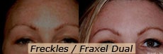 Fraxel Dual for Freckles
