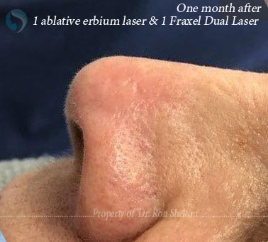 1 ablative erbium laser and one month after 1 Fraxel Dual laser.