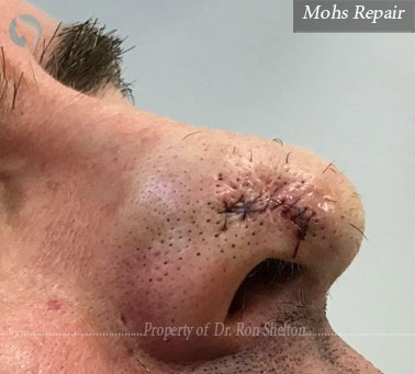 Mohs Repair on the nose