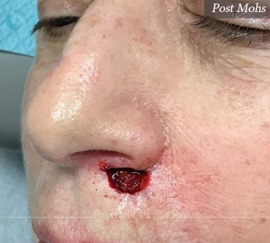 Mohs surgery on nose