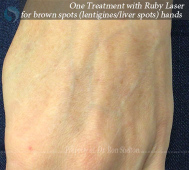 After One Treatment with Ruby Laser for brown spots (lentigines/liver spots) hands