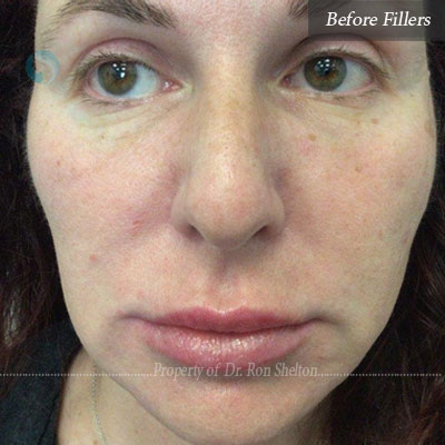 Before Fillers