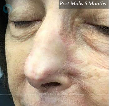 Post Mohs 4 Months on nose