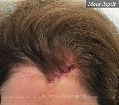 Mohs Repair on Forehead