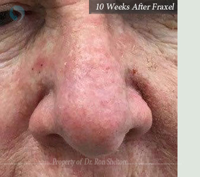 After Scar Revision with laser resurfacing
