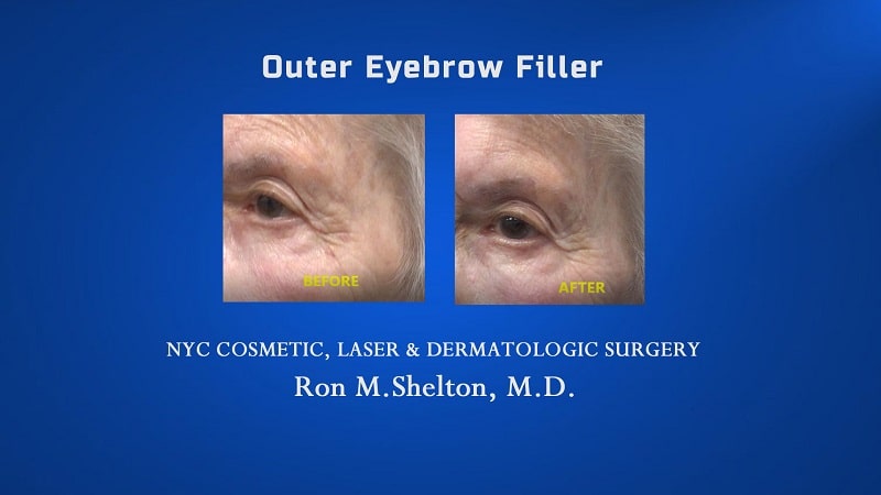 fillers for eyebrow