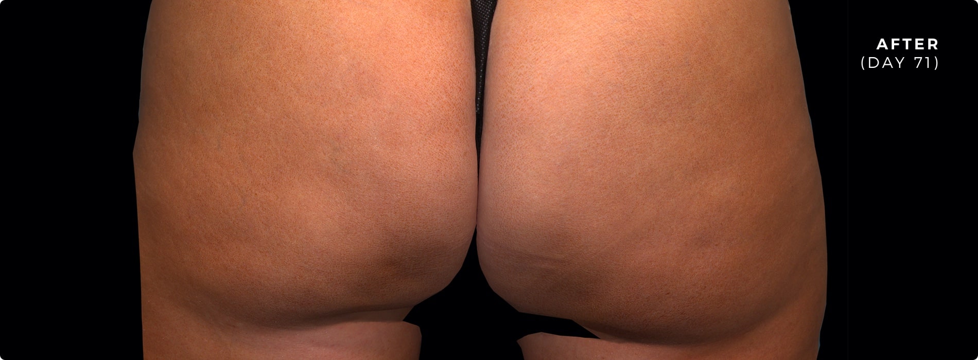 71 days after QWO for cellulite