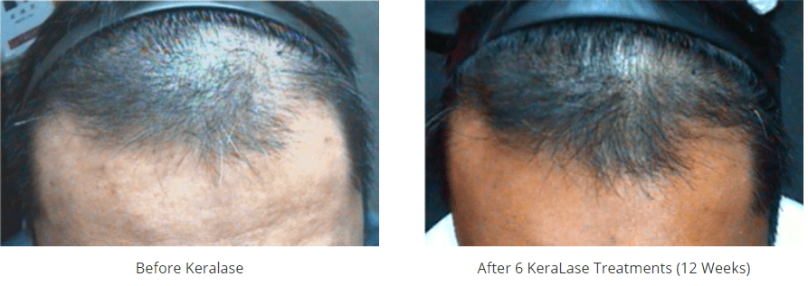 New Keralase Hair Stimulation For Hair Loss Ron Shelton M D