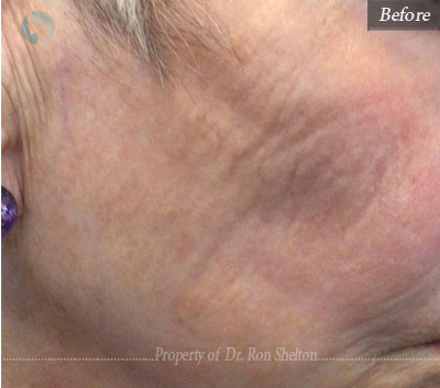 AquaGold microneedling with topical application of dilute Botox and Hyaluronic acid filler to improve texture of the skin.