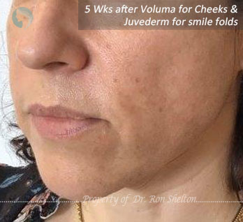 5 Wks after Voluma for cheeks and Juvederm for smile folds