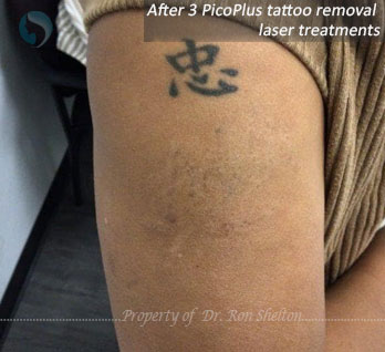 After 3 Pico Plus Tattoo Removal Laser Treatments in NYC