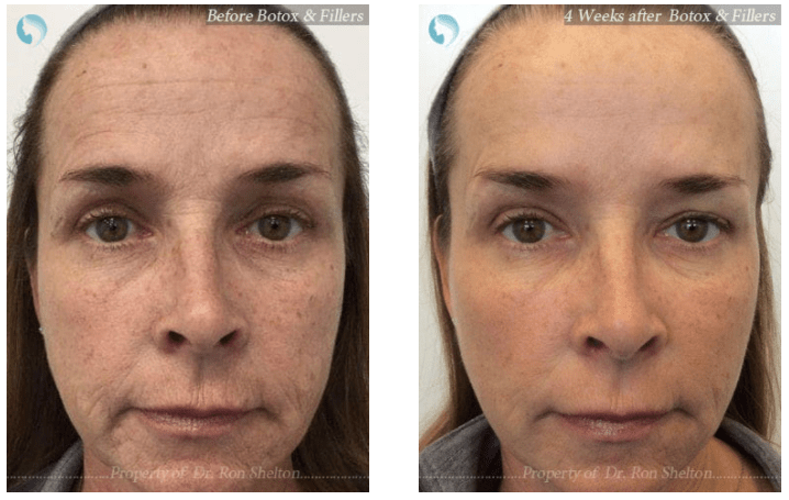 Botox and Filler combination treatment NYC