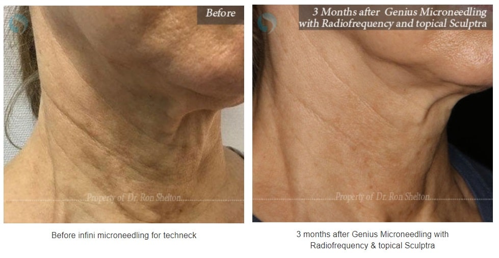microneedling for techneck nyc
