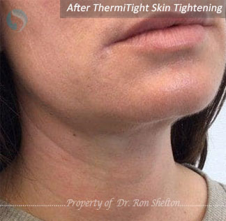 After thermitight skin tightening